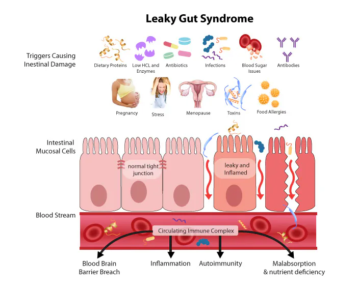 Diagram explaining the causes and effects of Leaky Gut Syndrome.