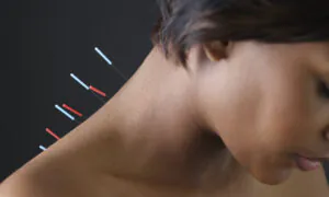 Acupuncture needles inserted along the neck of a person.